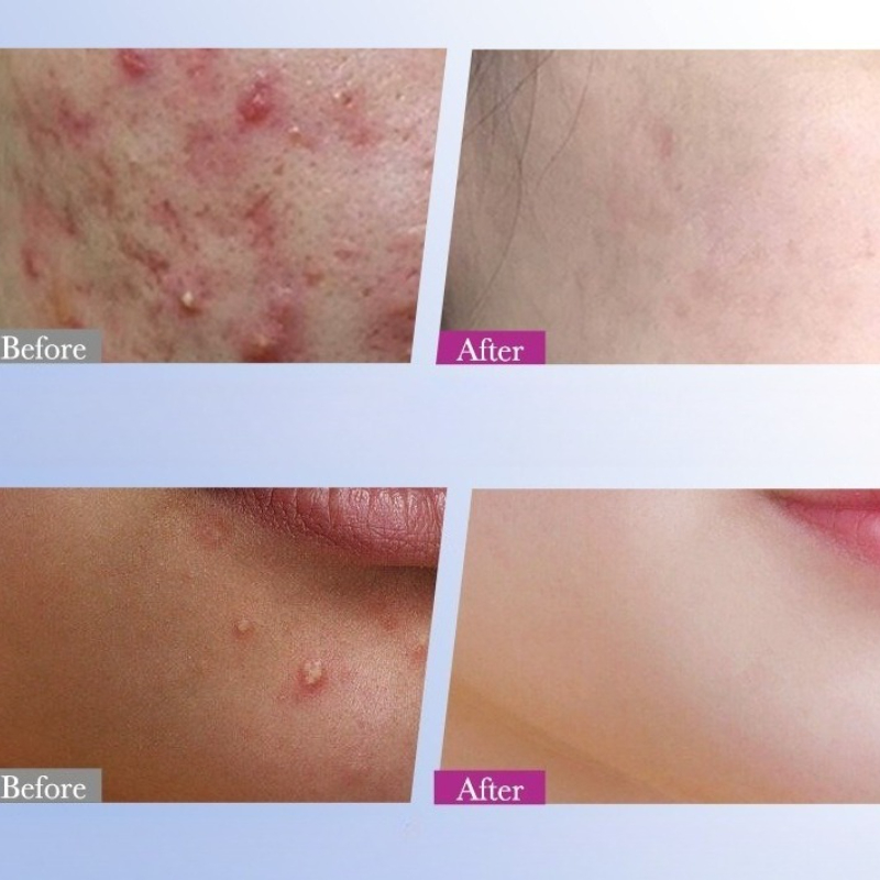 7/10/14 Pz Colorato Star Acne  - Skincare Qv recensione e prezzo
